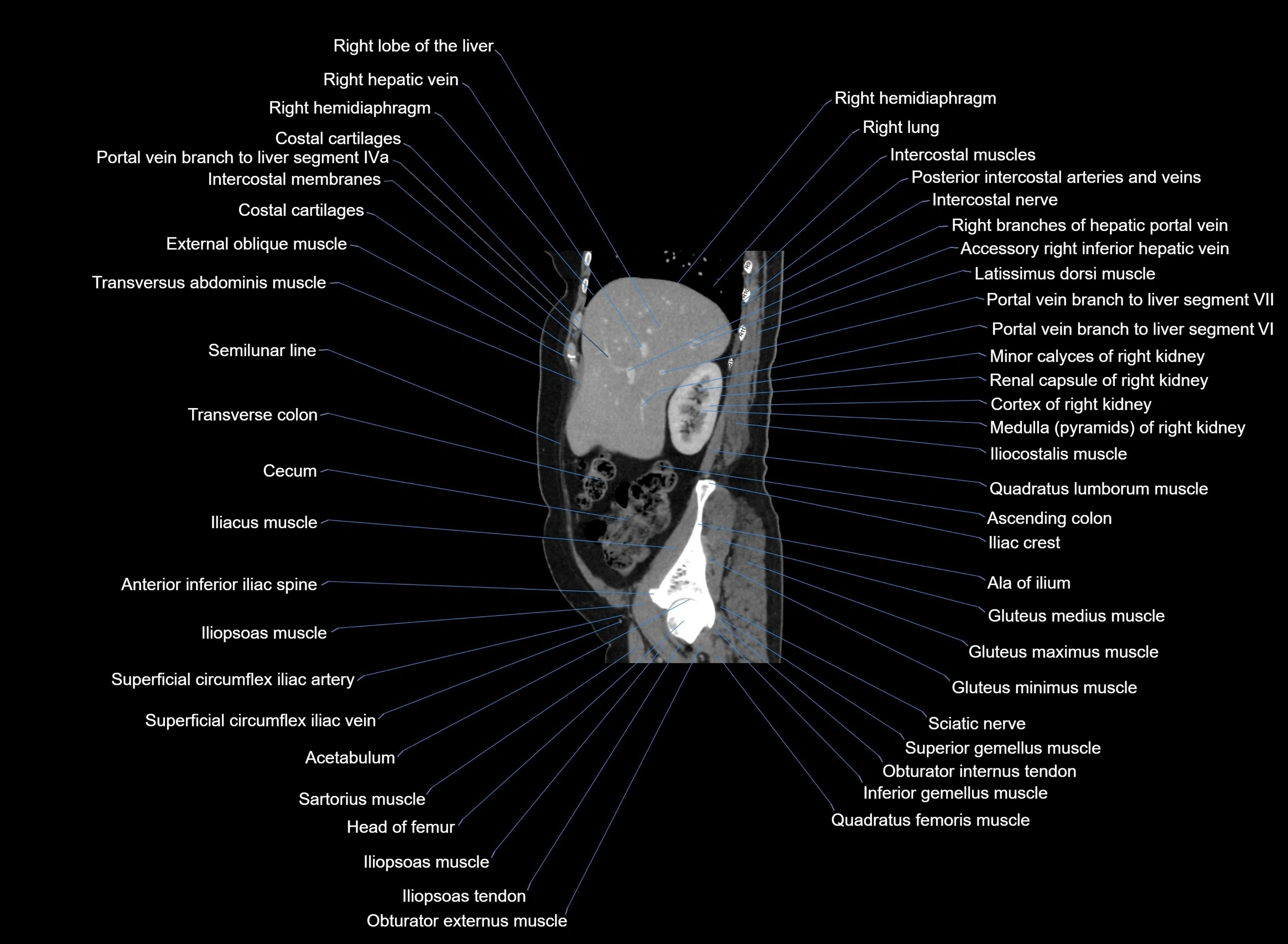 CT Abdomen sagittal cross sectional anatomy labelled radiology image -00085.webp